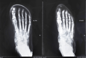 An x-ray of a foot in Altras (left) and conventional shoes (right).  